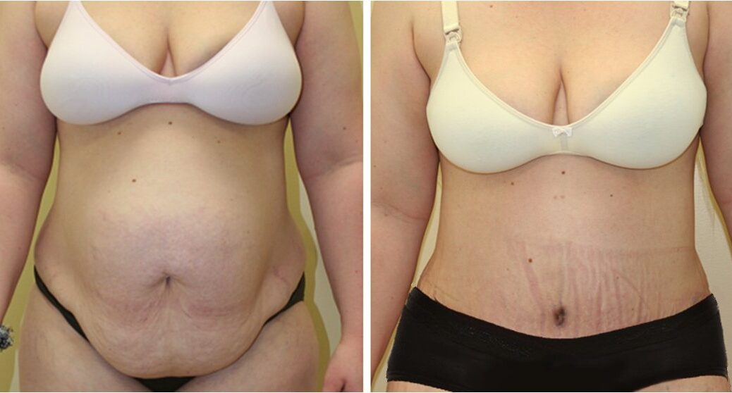 mommy makeover supérieur