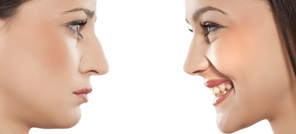 rhinoplastie pour Suisses