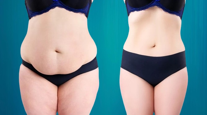 chirurgie ventre plat Suisses
