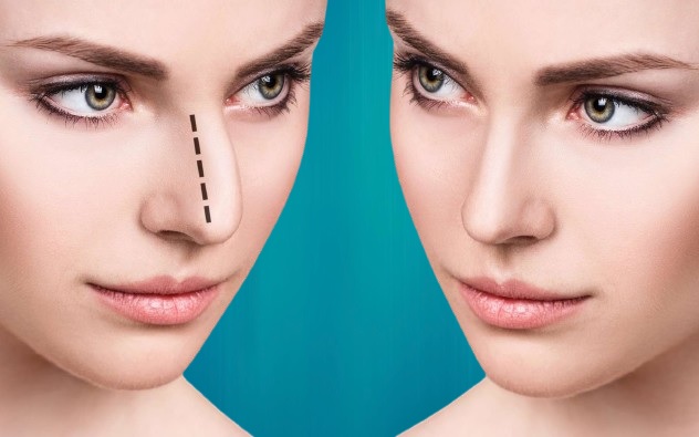 chirurgie septum dévié