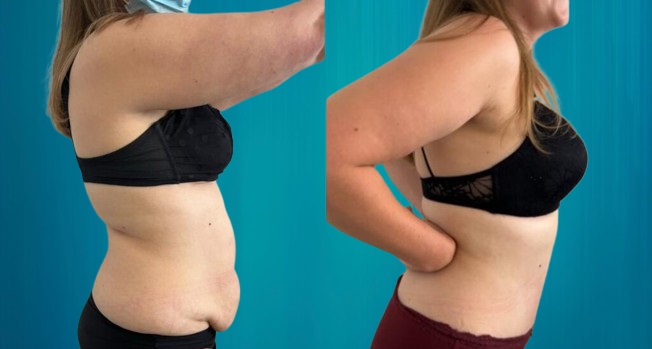 plastie abdominale
