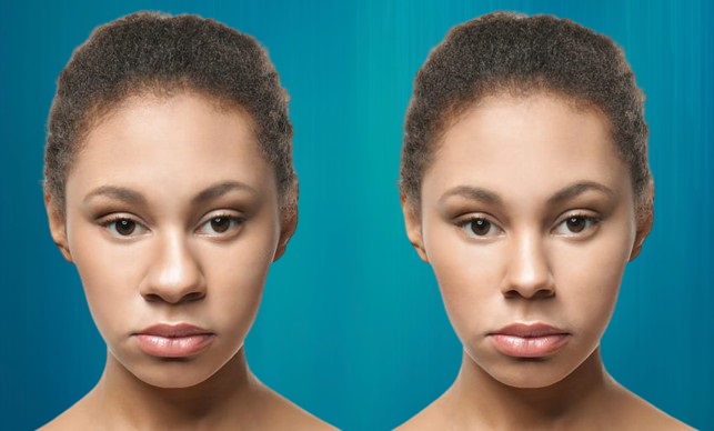 rhinoplastie ethnique Suisses