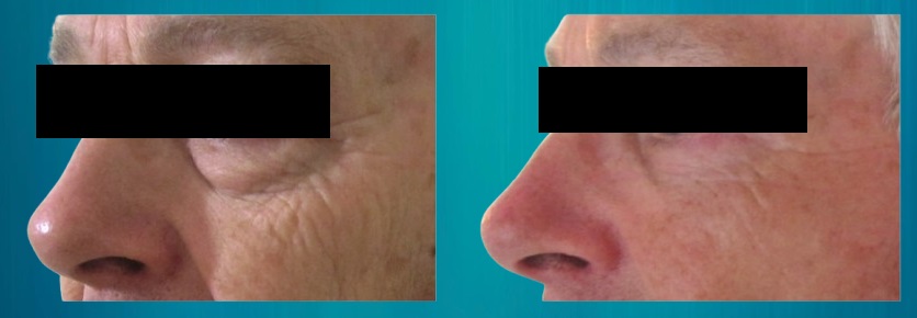 prix blépharoplastie Suisse