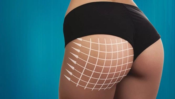 prix chirurgie fesses pour Suisses