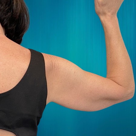 lifting bras pour Suisses