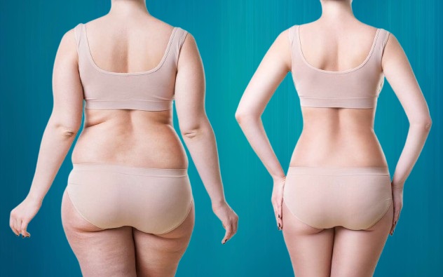 Liposuccion pour Suisses