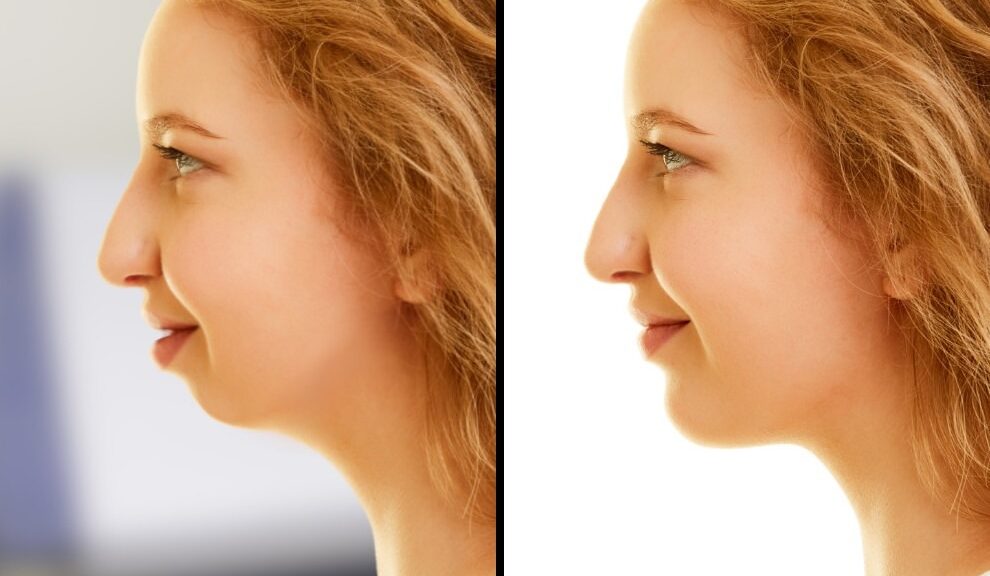 génioplastie