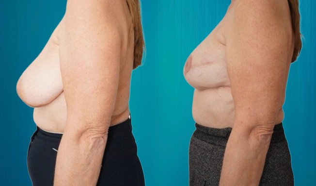 reconstruction seins pour Suisses