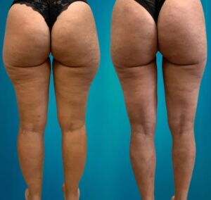 lipoaspiration des cuisses