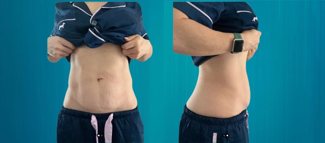 Mini-abdominoplastie pour Suisses