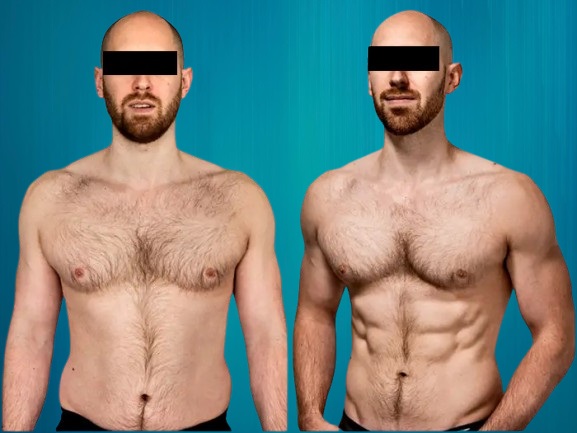 Chirurgie ventre plat pour Suisses