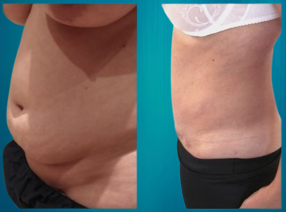 abdominoplastie et lifting