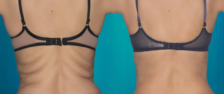Liposuccion et Renuvion J-Plasma