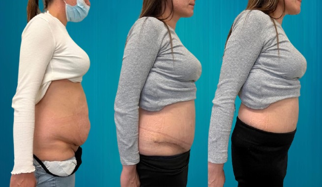 abdominoplastie pour Suisses