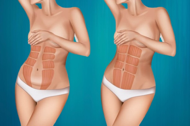 abdominoplastie pour Suisses