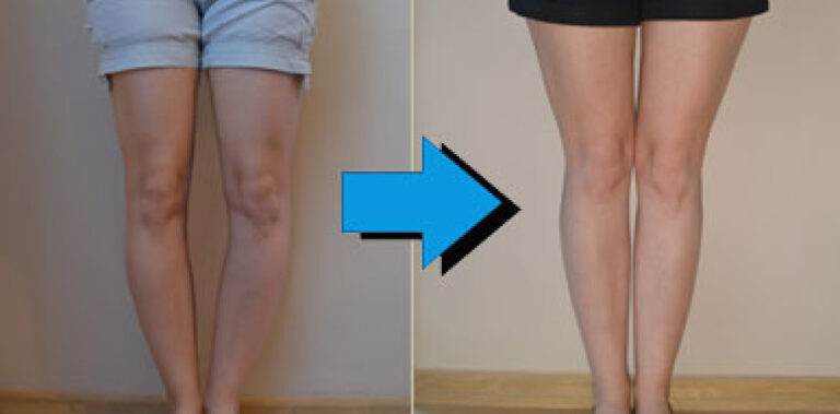 Comment Faire Pour Ne Plus Avoir Les Jambes Arquées Adulte