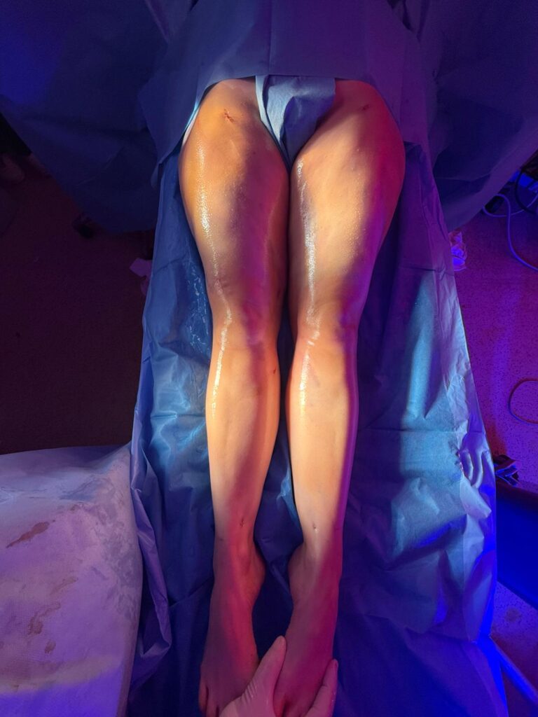 Résultat Après 4-TECH