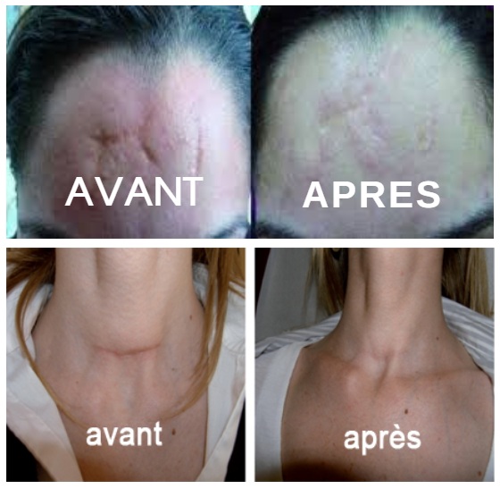 Traitement laser lesions tunisie