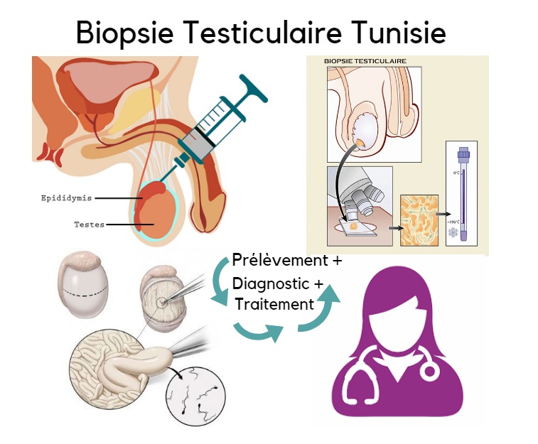 Biopsie testiculaire en tunisie