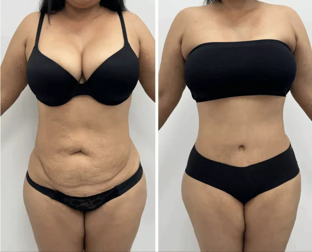 abdominoplastie tunisie avant apres