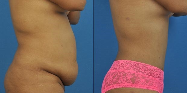 abdominoplastik vorher nachher