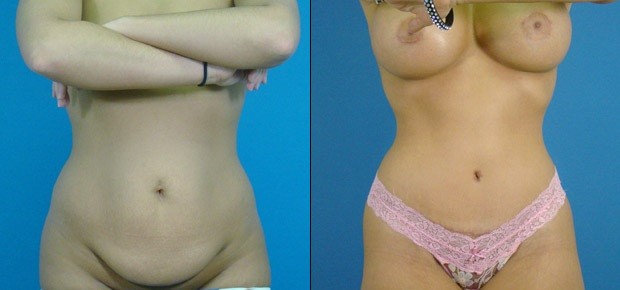 abdominoplastia e remoção de adipócitos