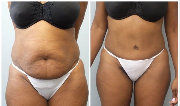 abdominoplastie et redrapage cutané