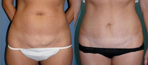 abdominoplastik in tunesien