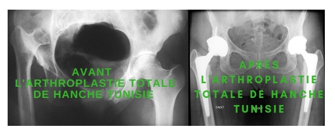 bilaterale arthroplastie tunesien