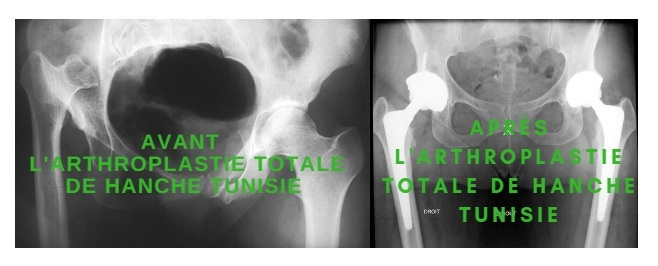 arthroplastie bilatérale tunisie