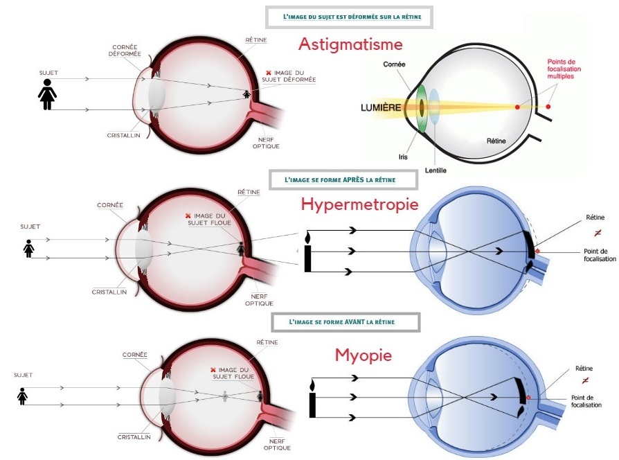  Lasik Tunesien