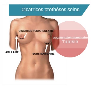 cicatrices augmentation mammaire tunisie