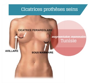 cicatrizes mamoplastia de aumento tunisia