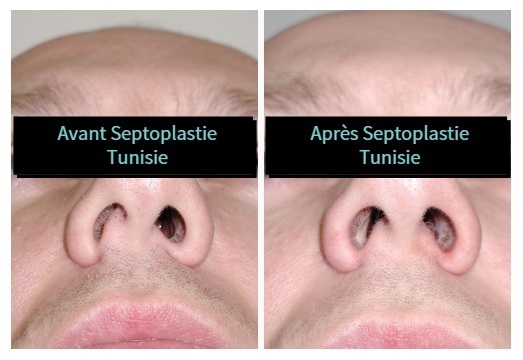 septoplasty vorher nachher