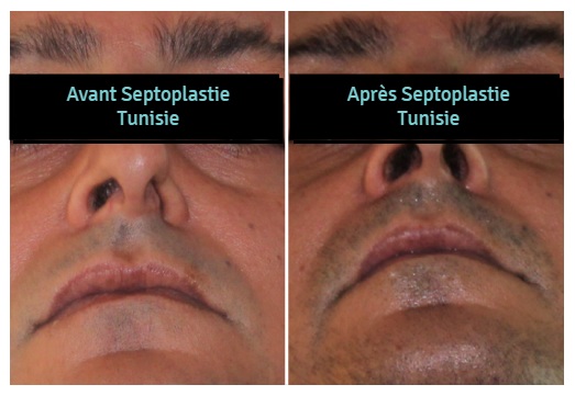 remodeler cloison nasale tunisie