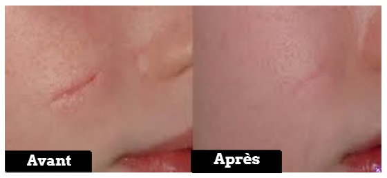 traitement par laser cicatrices tunisie