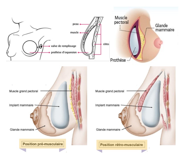 devis augmentation mammaire tunisie