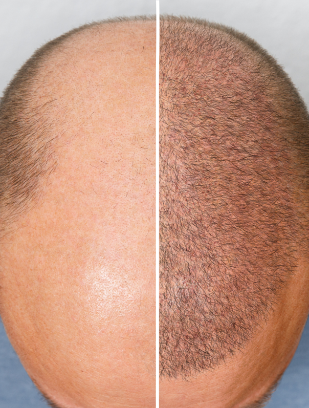 Pôle greffe de cheveux DHI Istanbul