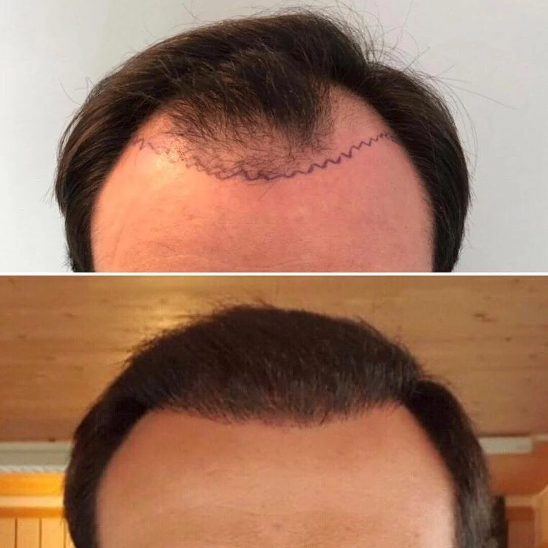 Ergebnis Haartransplantation