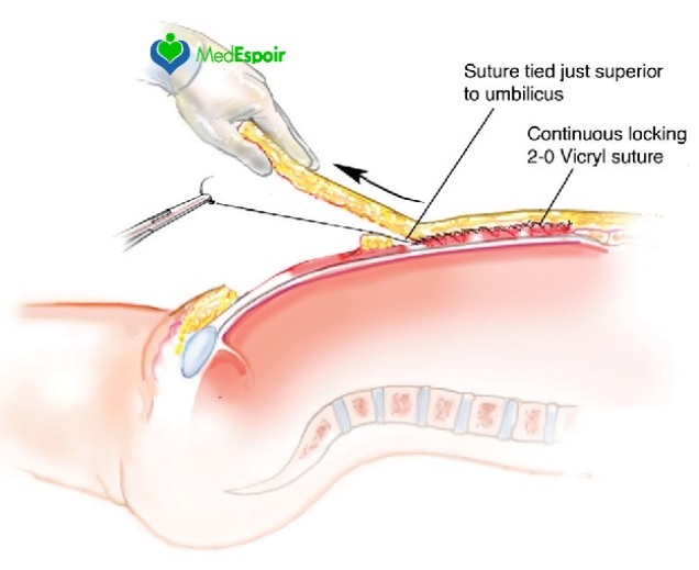 Cicatrice abdominoplastie photos tunisie