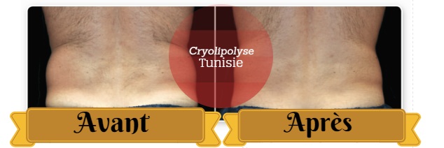 coolsculpting tunisie antes e depois