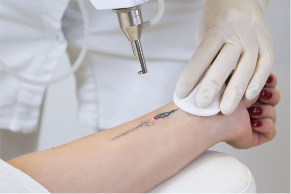 orçamento para remoção de tatuagens a laser