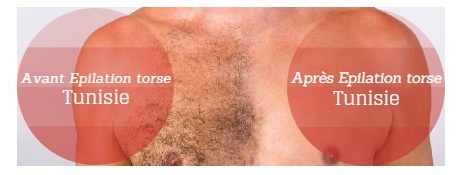 depilação Tunísia antes e depois