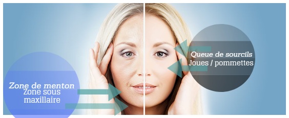 tensor thread facelift tunísia