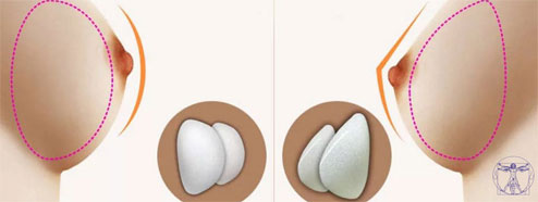 implant mammaire rondes tunisie
