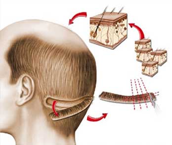 FUR Haartransplantation Tunesien