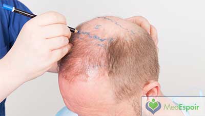 billige haartransplantation tunesien