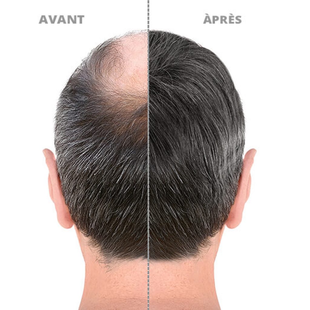 Ergebnis Haartransplantation