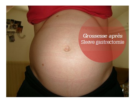 chirurgie bariatrique sleeve grossesse tunisie