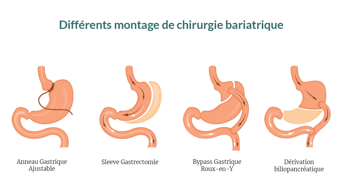 chirurgies esthetiques obésité pour suisses en Tunisie